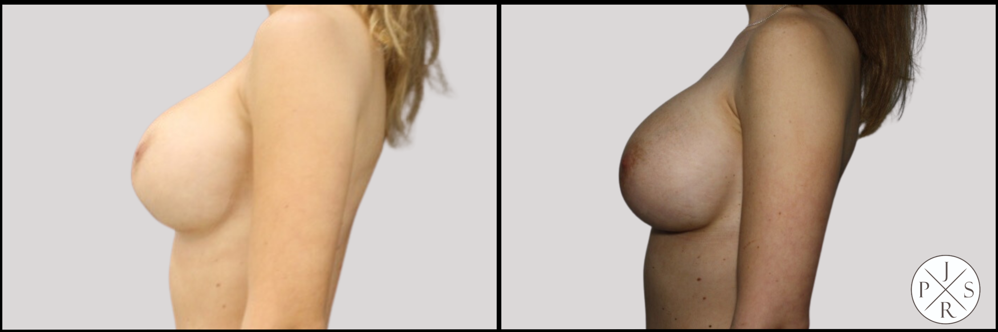 Breast Revision Before & After Image